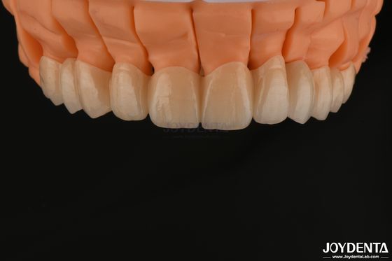 Купить Высокая эстетика слоистые циркониевые однокоронные мосты имплантат для зубной реставрации онлайн изготовление
