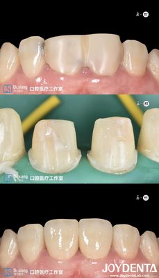 Купить Совершенно подходящие зубы Циркониевые зубные короны с системами CAD CAM для точной обработки онлайн изготовление