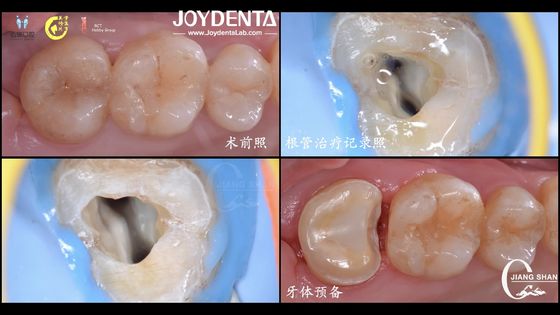 Купить Долговечная натуральная стоматологическая керамическая инкрустация точное соответствие высокая совместимость онлайн изготовление