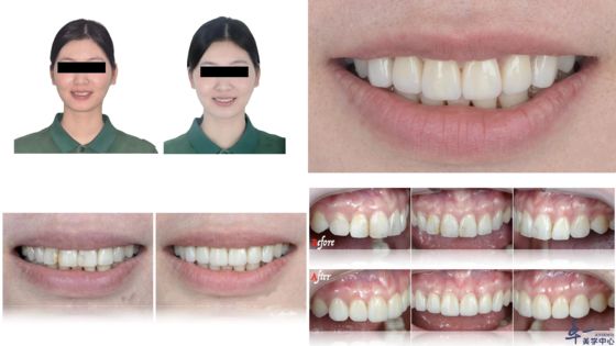 Купить Популярные продукты Joydentalab: симулированные эстетические фанеры онлайн изготовление