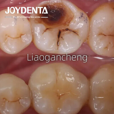 Купить Порцелановый зубной инлей восстанавливающий для взрослых и детей исключительная производительность онлайн изготовление