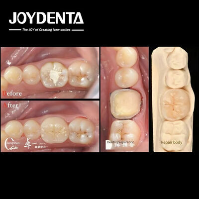 Купить Биосовместимость и высокая совместимость с естественным восстановлением зубов онлайн изготовление