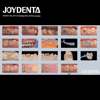 Купить Взрослые Дети Порцелановые керамические зубные инлей восстанавливающие для поврежденных зубов онлайн изготовление