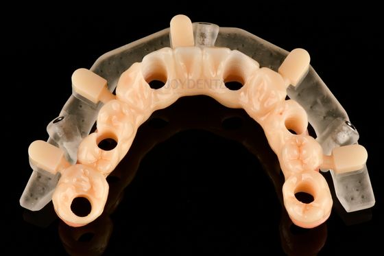 Специализированные 3D-печатные шаблоны для точной имплантации