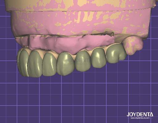 HIPAA Соответствующая безопасности данных Цифровая восковая 3D-модель для зубных модификаций