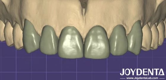 3D-печать Виртуальная цифровая воска Бесшовная совместимость с другим стоматологическим программным обеспечением