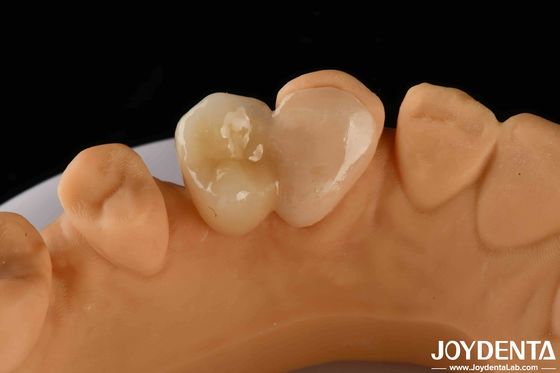 Emax Maryland Veneer клиническая сцепление для цвета совпадения зубного ремонта