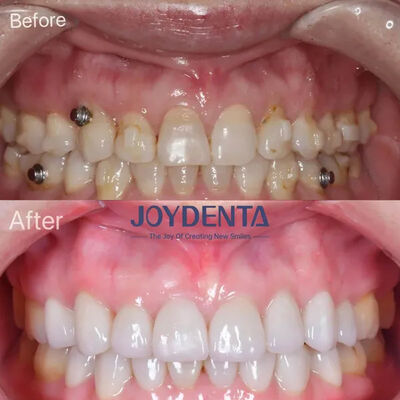 Зубные фанеры для отсутствующих зубов.