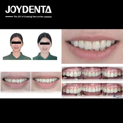 Популярные продукты Joydentalab: симулированные эстетические фанеры