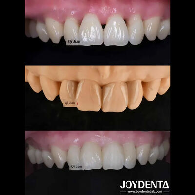 Фунеры для зубов от скорпионов - идеальное решение для натуральных прозрачных зубных фунеров