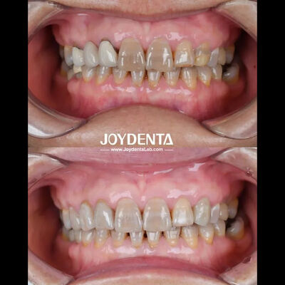 Легковесная стоматологическая циркониевая керамика для оптимального комфорта пациента. Естественный цвет.