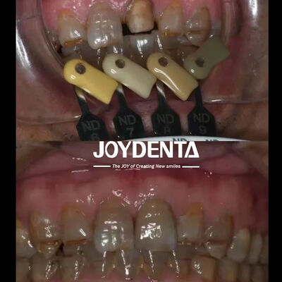 Прозрачные циркониевые короны с многослойной технологией градиента