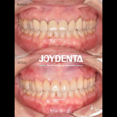 Стоматологический цирконий для безопасных тканей полости рта и совместимости с CAD/CAM