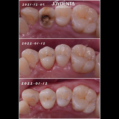 Вставка зубного фарфора для восстановления поврежденных зубов